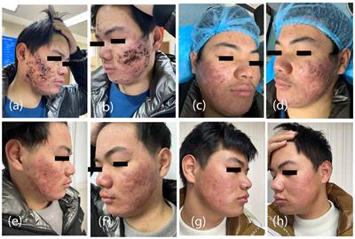 Case report: Acne vulgaris treatment with 5-Aminolaevulinic acid photodynamic therapy and adalimumab: a novel approach